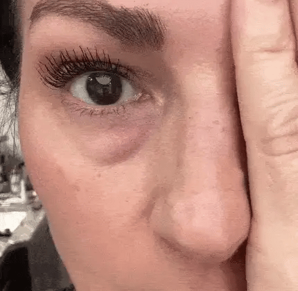 EyeLifter – Tratament Complet 3 în 1 anti cearcăne